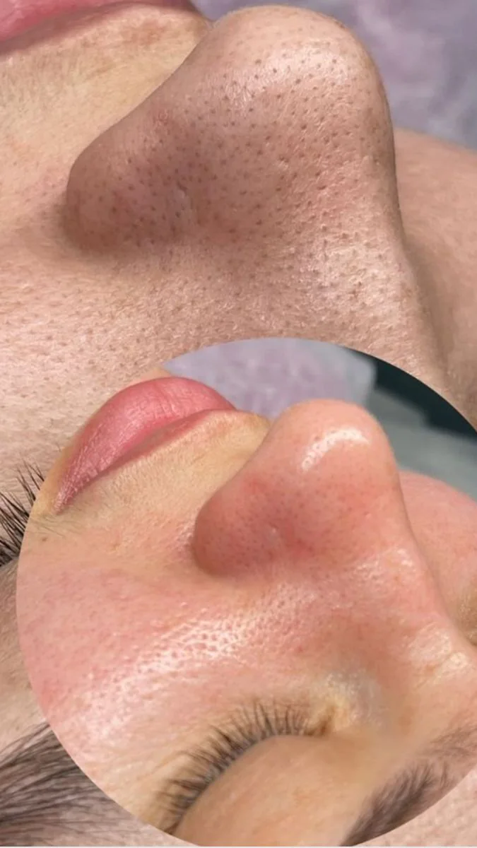 Representación ilustrativa de microneedling