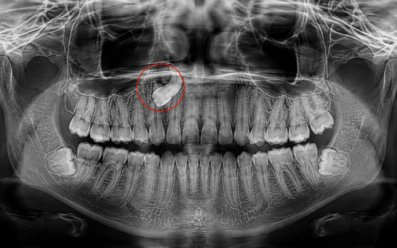 Representación ilustrativa de manejo de caninos y dientes incluidos