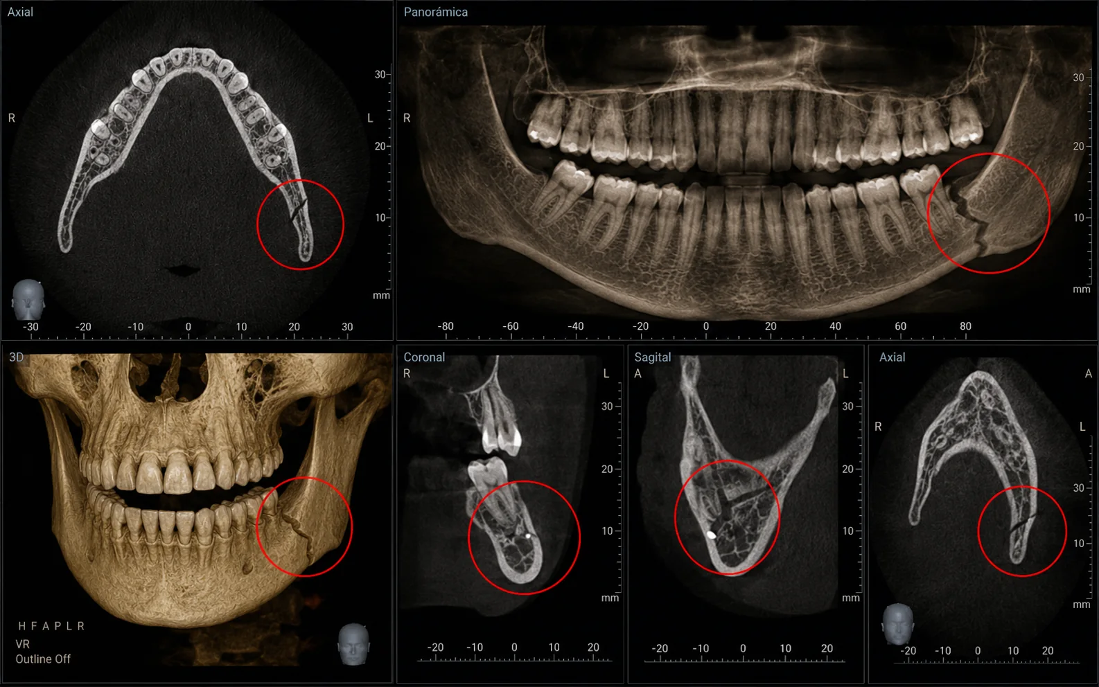 Representación ilustrativa de fracturas mandibulares y traumatismos faciales