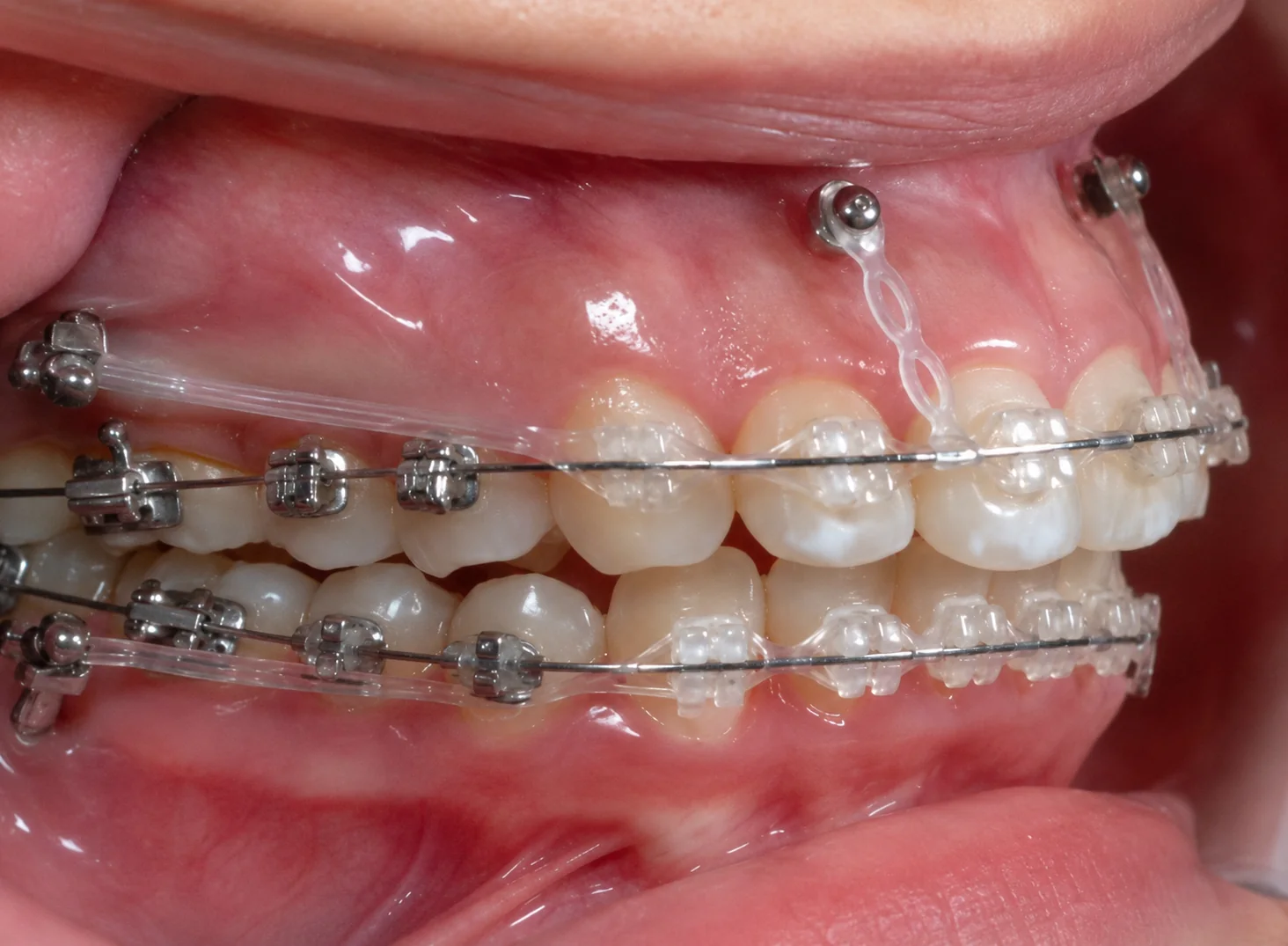 Representación ilustrativa de microimplantes de anclaje