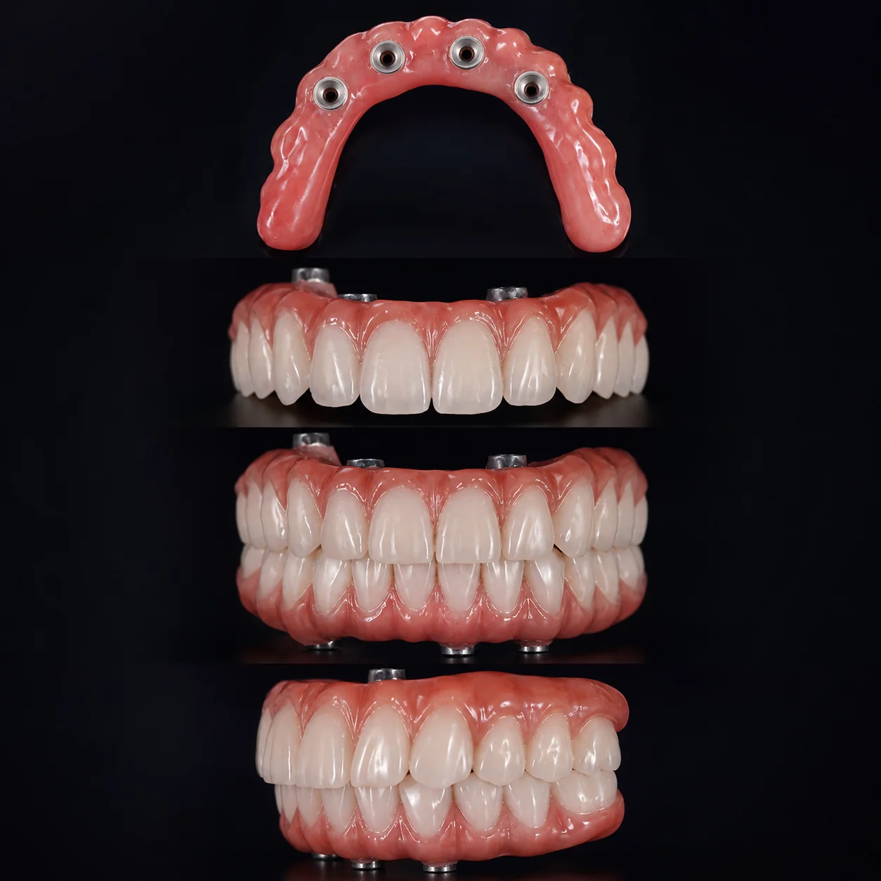 Representación ilustrativa de rehabilitación sobre cuatro implantes