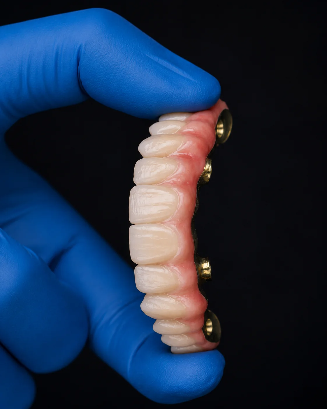 Representación ilustrativa de rehabilitación sobre seis implantes